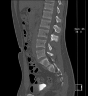 CT scan of a spine