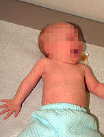 Infant with total brachial plexus palsy