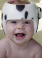 Child wearing helmet for deformational plagiocephaly