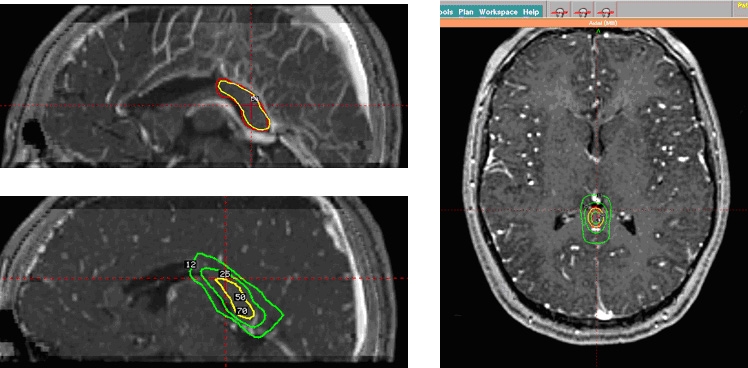 Targeting plan used to perform a posterior corpus callosotomy using the Gamma Knife
