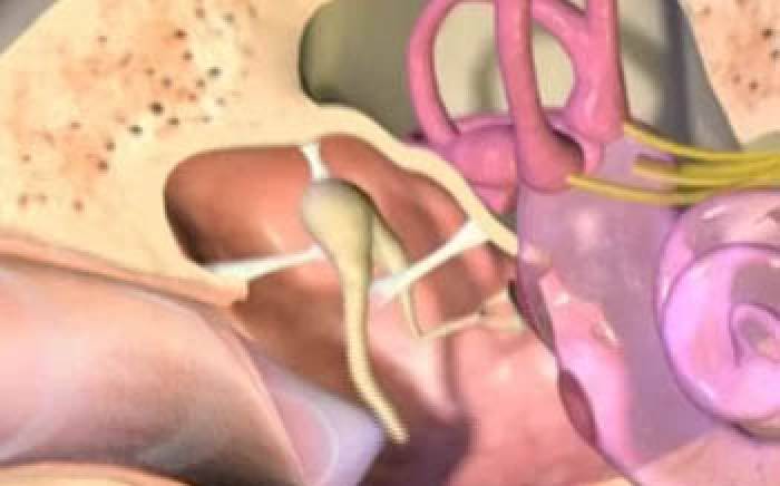 Medical Animation: Ear Tubes