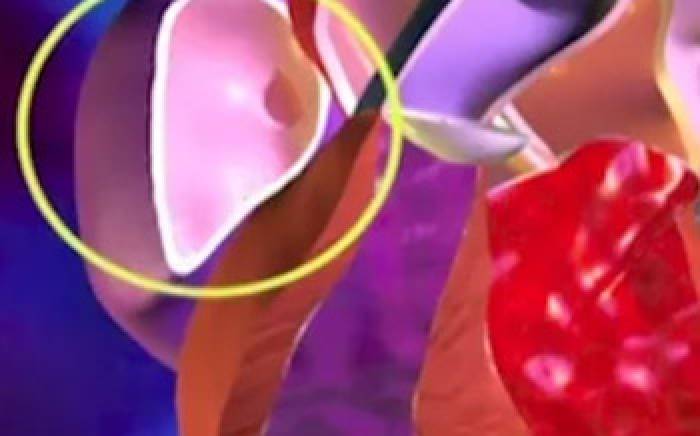 Medical Animation: Congenital Heart Defects