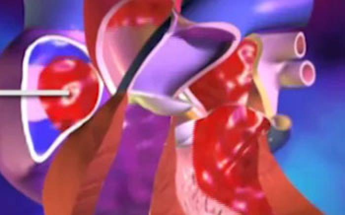 Medical Animations: Patent Foramen Ovale