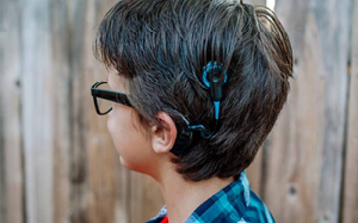 Cochlear implants for single-sided deafness