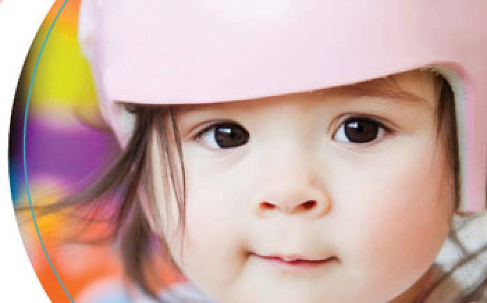 child with positional plagiocephaly