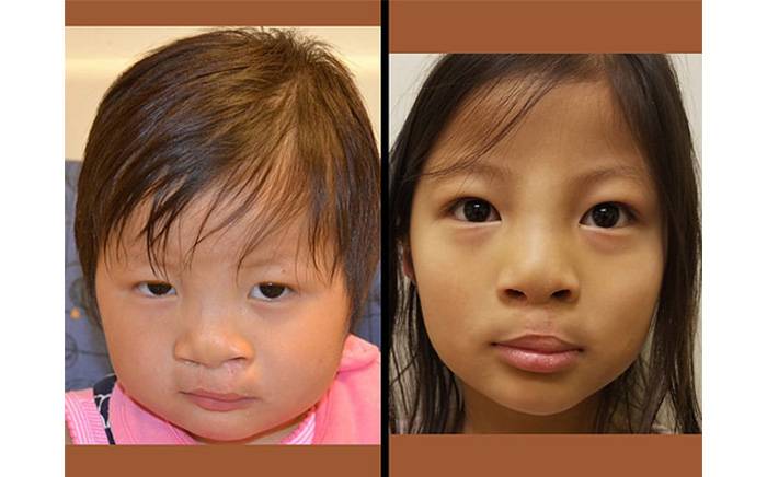 Child after complete revision of prior bilateral cleft lip repair at St. Louis Children's Hospital.