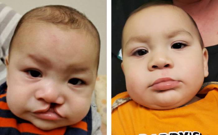 Child with a unilateral cleft lip and palate. Follow-up photo is after repair of his lip and nose.