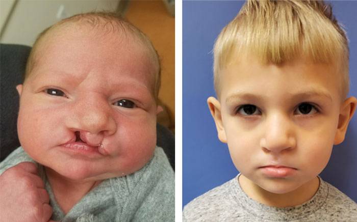 Child with a bilateral asymmetric cleft lip and palate. Follow-up photo is after repair of his lip, nose and palate.