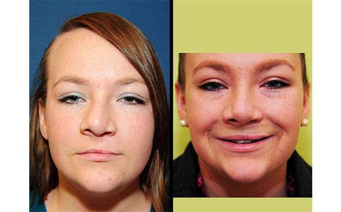 15 yo female with left-sided cleft lip who had a nasal deformity and difficulty breathing through her nose.