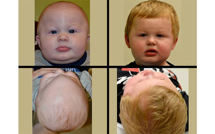 Child was born with metopic synostosis (left). (right) One year after open craniosynostosis repair at St. Louis Children's Hospital.