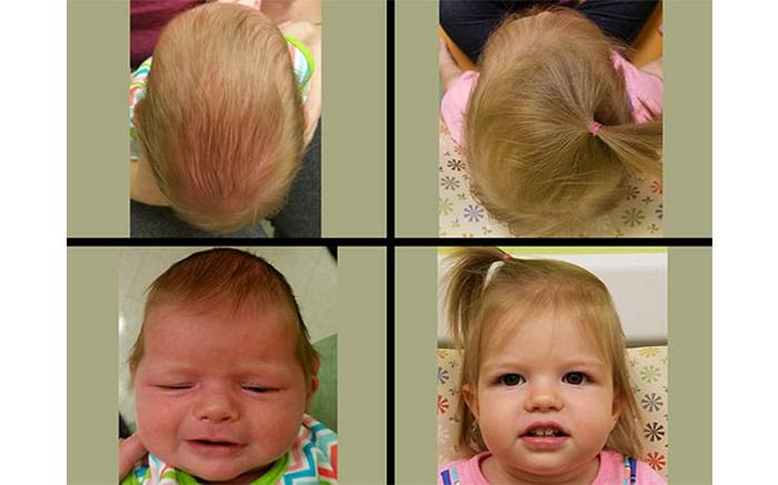 Before and after photos of a child with Sagittal synostosis from St. Louis Children's Hospital.