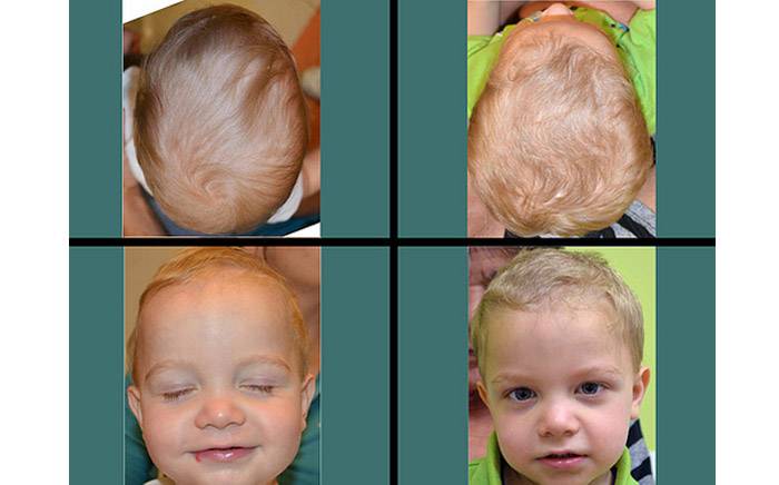 Child with sagittal synostosis before surgery (left). Postoperative 1 year after open reconstruction with increase in head width (right).