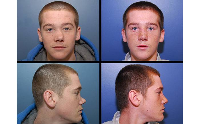18 year old male with severe nasal deformity due to an injury when he was an infant. He had reconstruction of his nose with a bone graft to reshape his nasal structure. 