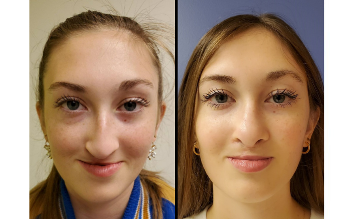 Before and after Le Fort I midface advancement and cleft rhinoplasty