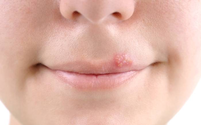 Can Kids get Cold Sores?