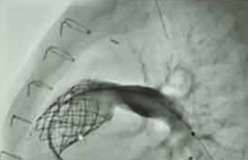 Kayla Melody Heart Valve