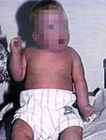 Infant with Erb's palsy