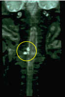 MRI showing pseudomeningocele