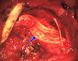 Operative photograph of nerve grafting in the upper trunk