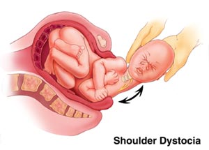 Shoulder dystocia