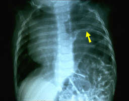 X-ray of phrenic nerve injury