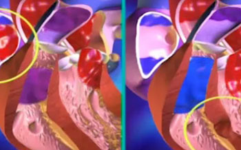Medical Animations: Atrial Septal Defect and Ventricular Septal Defect |  St. Louis Children's Hospital