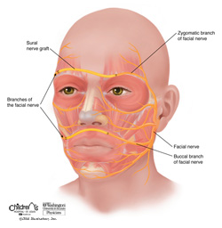 Cross-facial nerve graft