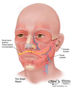 Free functional muscle transfer with cross-facial nerve graft