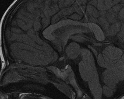 Brain MRI