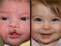 Cleft Palate Photo Gallery