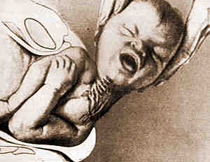 السحب الشديد للضفيرة العضدية عند الولادة