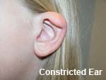 contricted ear