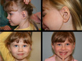 Ear Surgery Gallery