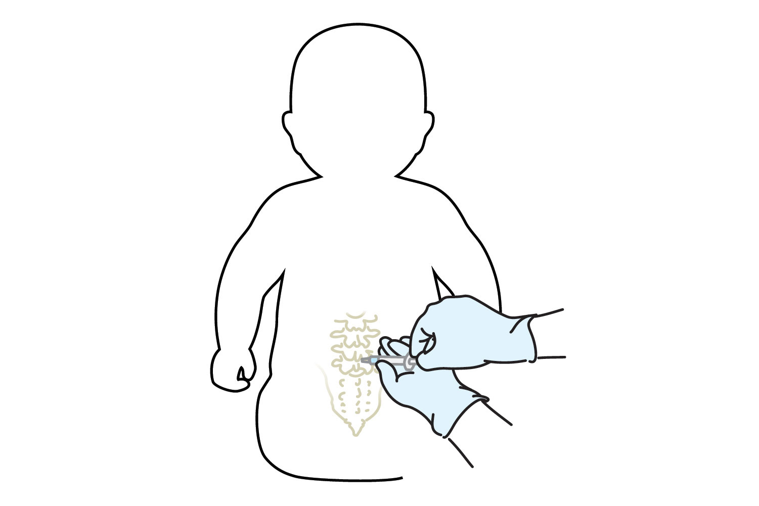 Illustrative image showing spinal anesthesia injection on a baby
