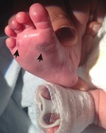 DOL 5: new ecchymotic lesions of bilateral feet