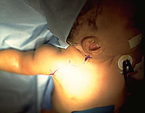 paciente na cirurgia e a incisão