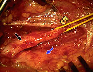 Fotografia operatória da neurólise