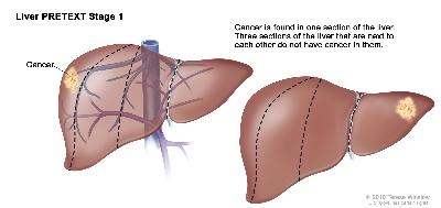 Pediatric liver cancer pretext stage 1