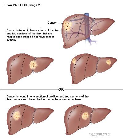 Pediatric liver cancer pretext stage 2