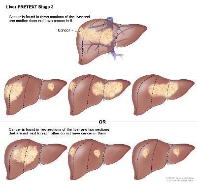 Pediatric liver pretext stage 3 cancer. 