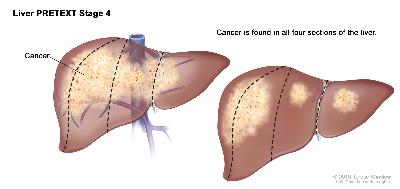Pediatric liver cancer pretext stage 4 cancer 