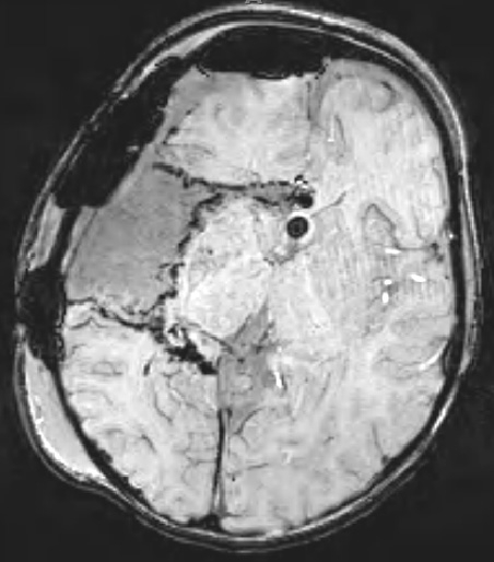 right-sided peri-insular hemispherotomy