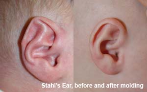 stahls ear before and after molding