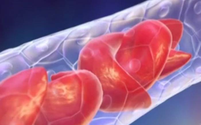 Medical Animation: Sickle Cell Anemia