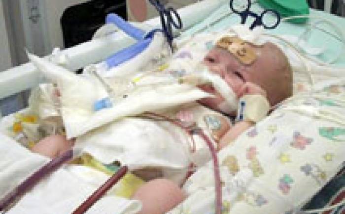 Newborn Baby Receives First Artificial Lung as Bridge to Lung Transplant