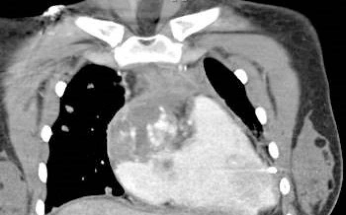 Case Study: Final Exam Stress