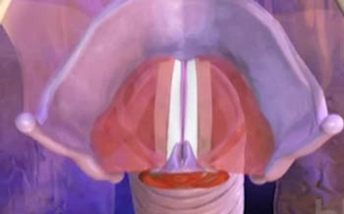 Medical Animation: Laryngitis