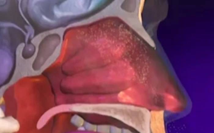 Medical Animation: Allergic Rhinitis