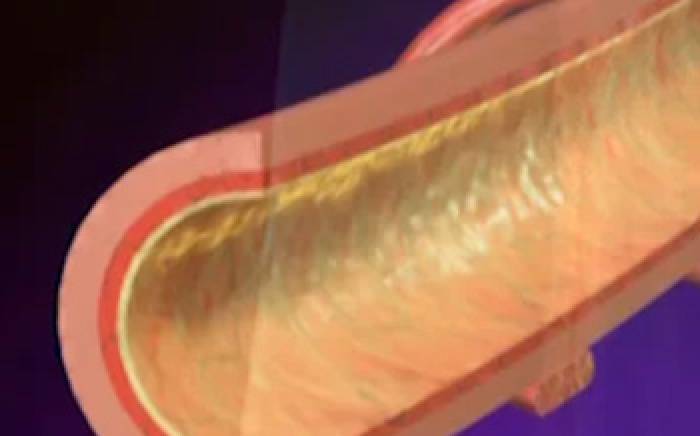 Medical Animation: Bronchitis