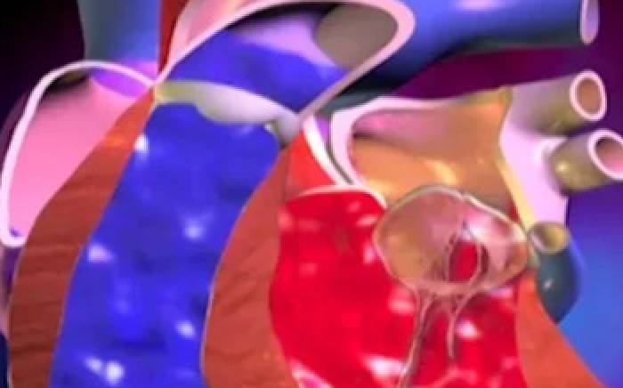 Medical Animation: Valvular Regurgitation